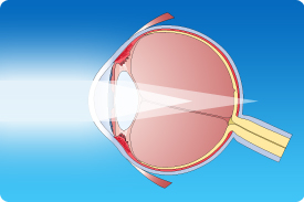 What are contacts for astigmatism?